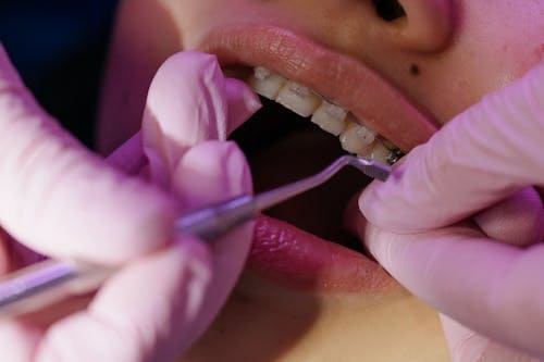 braces