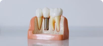 Dental Implants